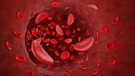 Understanding Sickle Cell Disease and the Lifeline of Blood Donation in Kenya